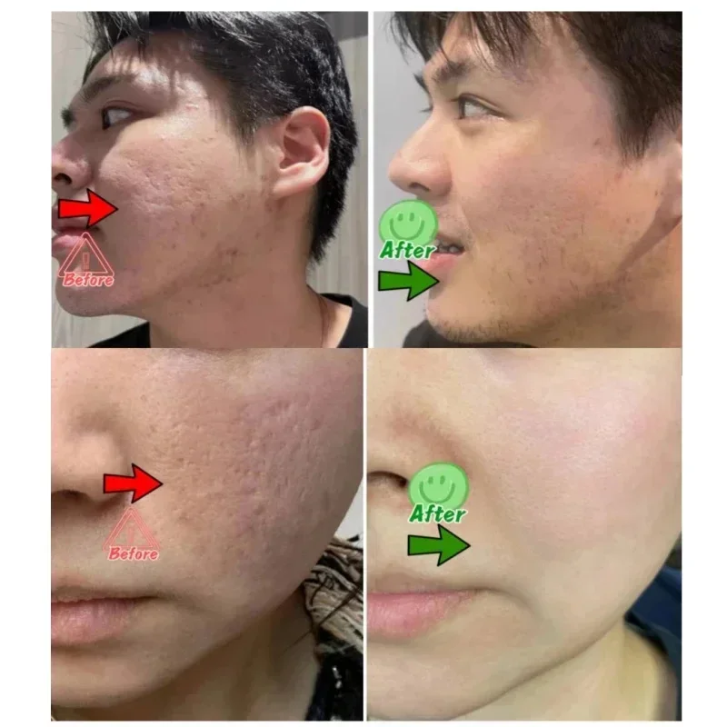 حمض الساليسيليك كريم إزالة الم - مراجعة Salicylic Acid Blackhead Remover وسعره