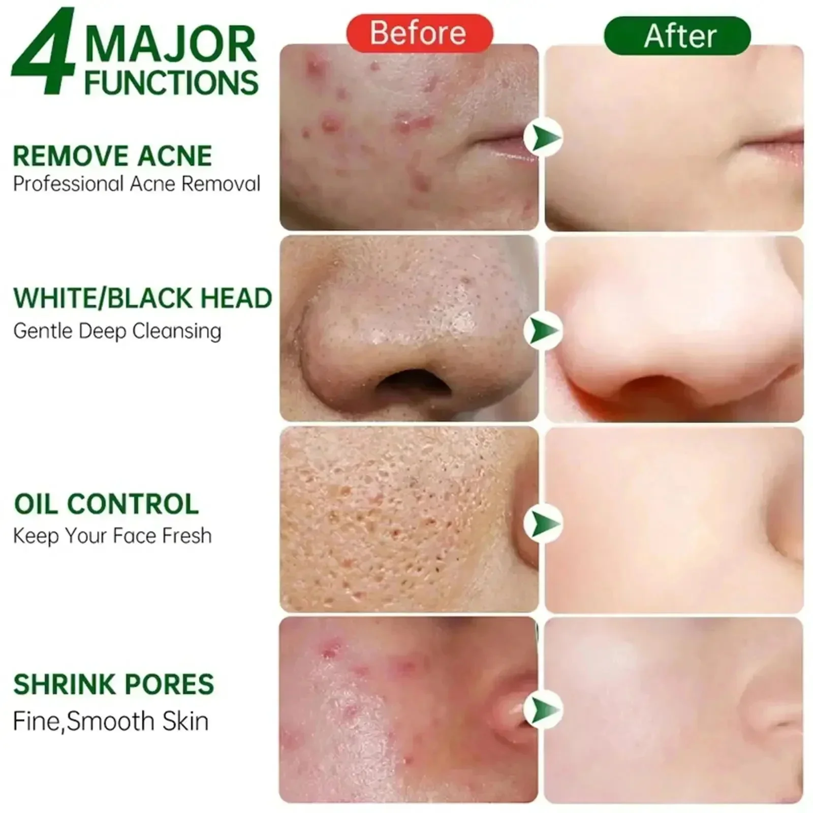 حمض الساليسيليك كريم إزالة الم - مراجعة Salicylic Acid Blackhead Remover وسعره
